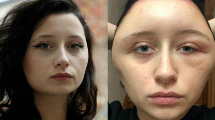 Efek Alergi Cat Rambut, Kepala Mahasiswi Cantik ini Membesar Dua Kali Lipat