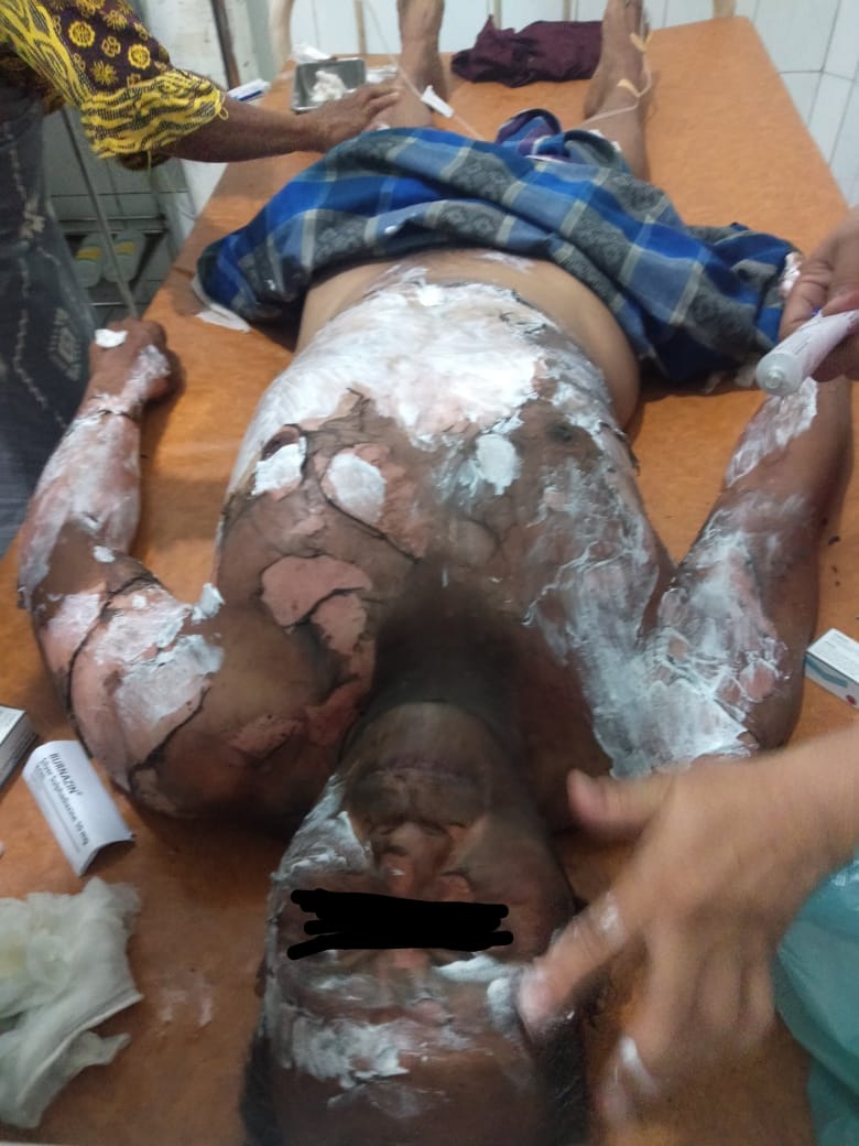 Cekcok Mulut Berujung Petaka Suami di Bakar Istri Muda
